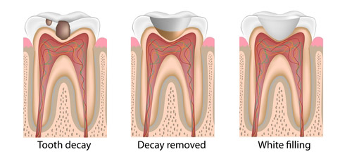 Fillings - DAY AND NIGHT DENTAL