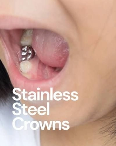 stainless crowns